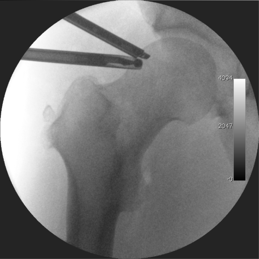 Hip Arthroscopy Surgery
