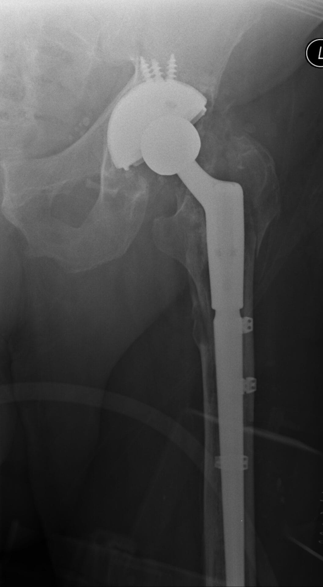 Revision Hip Replacement