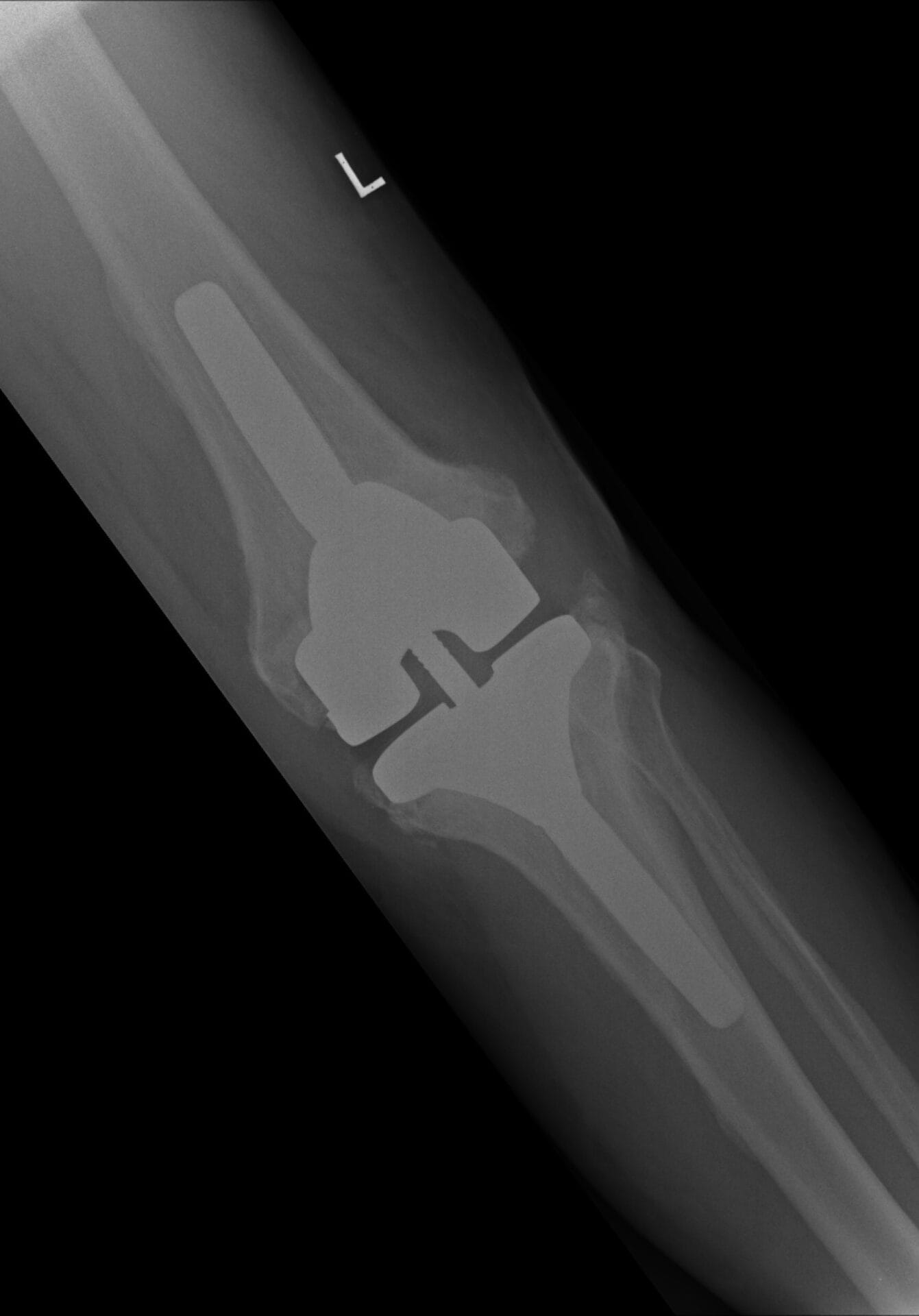 Revision Knee Replacement